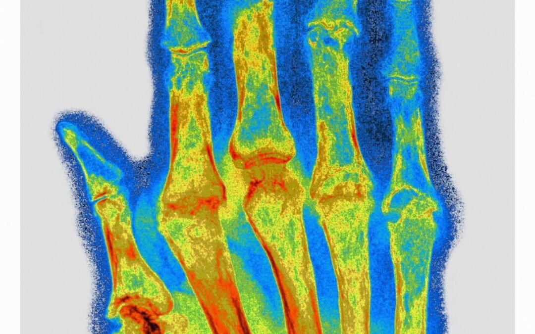 Vers un implant pour soigner la polyarthrite rhumatoïde ?